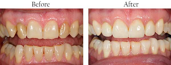 Bellingham Before and After Dental Implants